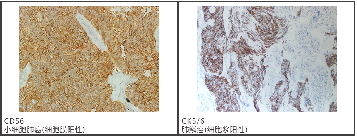 1635746368196833.png 肺癌6.png