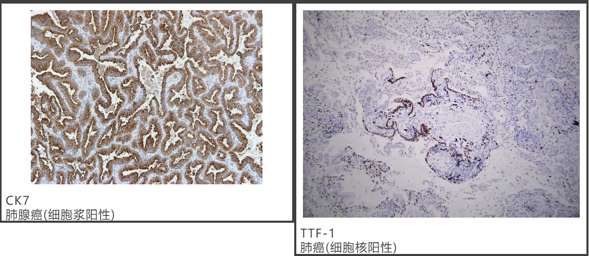 1635746378110875.png 肺癌7.png